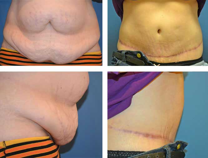 Tummy tuck procedures | Pioneer Valley Plastic Surgery | Springfield, MA