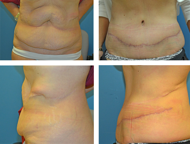 How can you take good before and after photos of your tummy tuck?