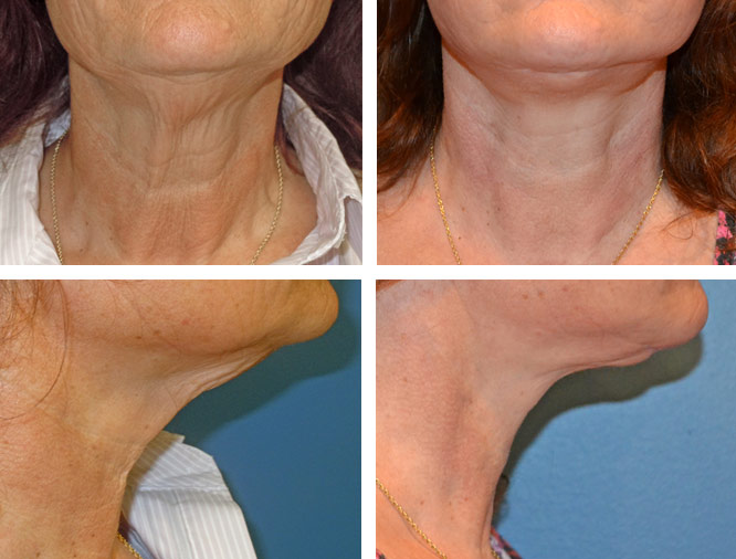 What is the cost of a facelift or neck lift?
